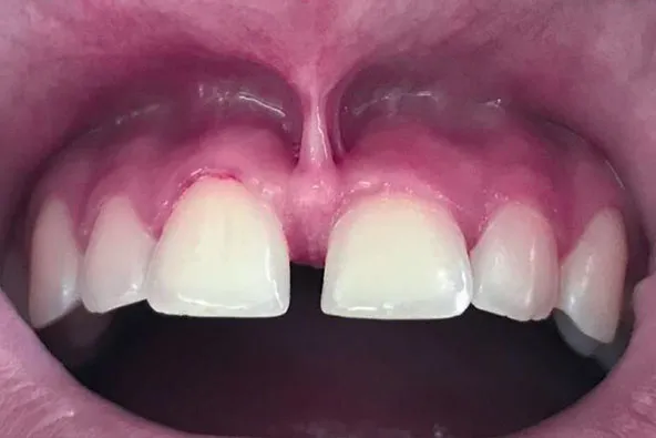 Imagem de uma boca aberta com os dentes aparecendo.